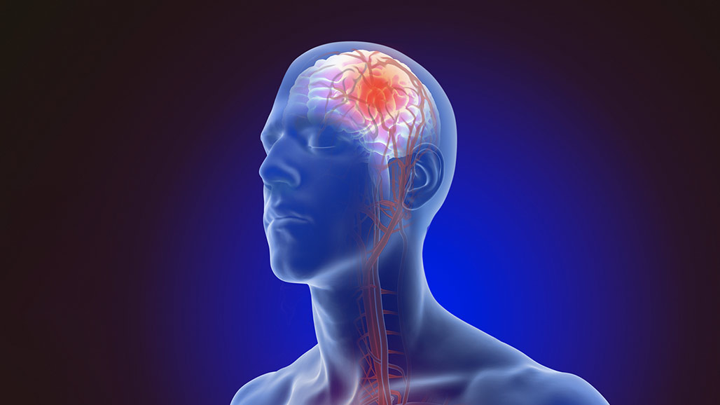 First Cardiology Consultant - stroke