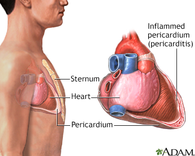 First Cardiology Consultant - Pericarditis